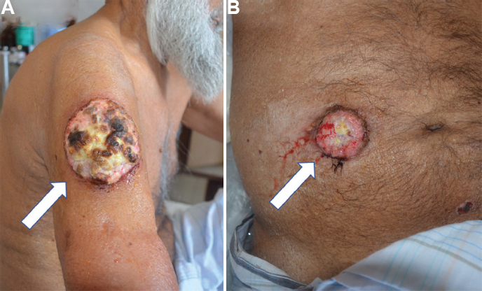 Response to radiotherapy in (A) shoulder lesion and (B) abdominal cutaneous lesion.